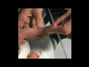 Parent guide to club foot stretches: Step 1