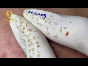 Removal Blackheads and whiteheads (378) | Loan Nguyen