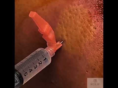 Incision & Drainage of a large Left lateral thigh abscess