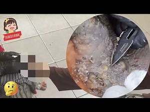 🤯 Extreme Jigger Removal – Hidden Parasites Under Rotting Skin! #BT219