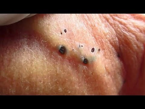 Ear Blackheads of Year! Best Blackheads of 2018