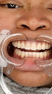 15K views · 13 reactions | Composite resin, known for its natural appearance and durability, allows us to correct imperfections in your teeth, such as stains, cracks, or unwanted spaces. With skill and precision, we will sculpt each tooth to achieve perfect harmony with your face and personality. | Dental Design Smile | Facebook