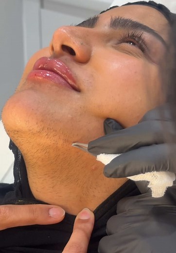 Trying Botox for the First Time: Natural, Smooth Results