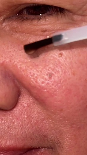 Satisfying Blackhead Removal Techniques