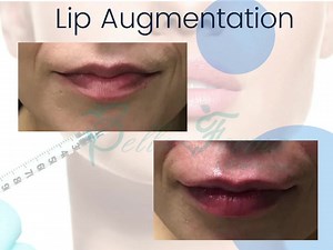 Pucker up and be smooch ready for this Valentine’s Day!  Take advantage of our filler promos! and Keep an eye for our February promotions! ♥️ #lipfiller#lip#valentines#filler#lipaugmentation#botox#atl#injectables#johnscreek#beforeandafter#plumplips#plumpit#atlmedspa#medspa | Bella Forma Cosmetic Surgery Center and Medical Spa | Facebook