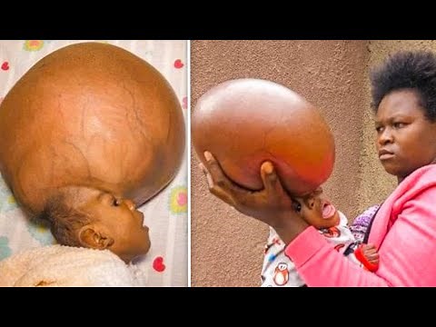 Baby Boy Is Born With Swollen Head, But Doctors Are Shocked When They See Him 6 Years Later