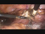 Laparoscopic Treatment for Symptomatic Cystocele. The Transversal Suspension. • Video • MEDtube.net