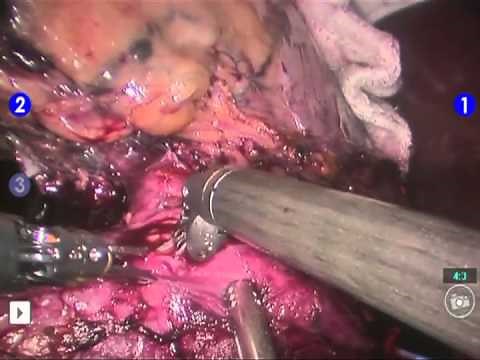 Inferior Vena Cava (IVC) Thrombectomy - da Vinci Robotic Surgery