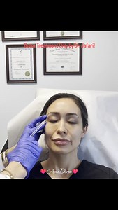 �👁 Botox injection for treatment of lines and wrinkles in forehead, glabella, frown lines & crow's feet (can also be done with Dysport, Jeuveau/Newtox, Xeomin or long-acting Daxxify) ___ 💉 Procedure: Botox injection by experienced MD ___ 🎯 Purpose: Reducing the appearance of wrinkles and fine lines on the forehead, crow's feet, glabella, frown lines, smoker's lines, neck bands and more! ___ 💊 Product used: Botox, Dysport, Jeuveau, Xeomin or Daxxify ___ 🌹 Results: Results appear within days 