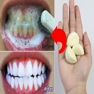 11K views · 579 reactions | Garlic and onion may get a bad rep for bad breath, but they can give you healthier and whiter teeth by releasing bacteria-reducing compounds when eaten raw. Garlic contains antibacterial properties shown to help kill tooth pain on contact. The antibacterial properties break down the bacteria build up on your teeth and causing you to experience the tooth pain | Health Zone | Facebook