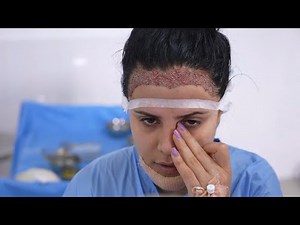 Female Hairline Lowering: Hair Transplant | Surgical Hairline Advancement