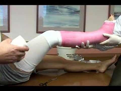 application of a long leg cast