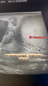 Inguinal hernia #inguinalhernia #strangulation #radiologist #ultrasoundmadeeasy | Ultrasound made easy