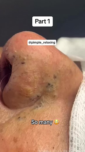 #pimplepoppersatisfying #Acne #Pimple #blackheads #satisfying #blackhead# (706)