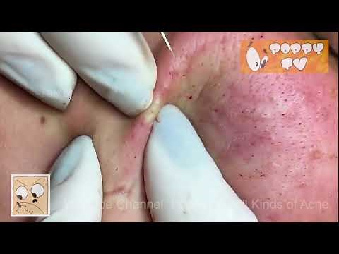 ❤️ BLACKHEADS Extraction Compilation 01 Comedones on Cheeks ❤️