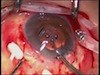 IOL and Capsule Tension Ring Dislocation in Glaucoma Case - Eyetube