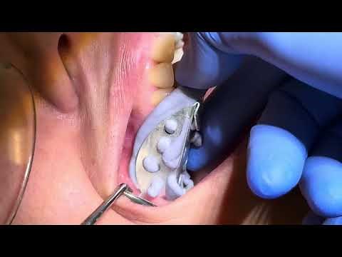 Temporary Crowns procedure