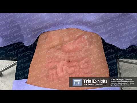 Trocar Placement for Lap Band Removal Procedure