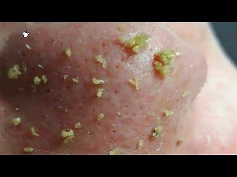 How To Remove Blackheads And Whiteheads On Nose Easy ✦ Dr Laelia ✦