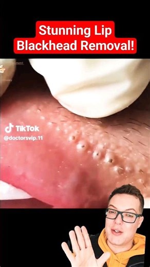 Crazy Painful BLACKHEAD REMOVAL AROUND LIPS - Super Satisfying #shorts