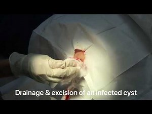 Drainage and removal of an infected cyst on the back