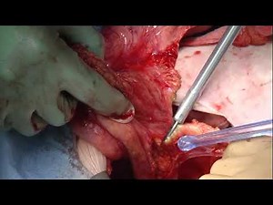 Rectopexy Procedure with THUNDERBEAT OEJ - Olympus - Dr. Lane
