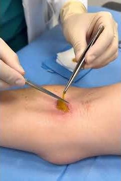 sebaceous cyst EXPLODES #shorts