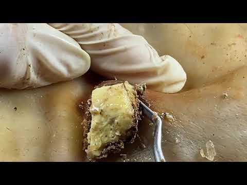 Most Satisfying Giant Zit Popping & Blackhead Extraction ASMR M56607