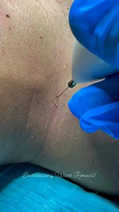 Warts are viruses transmitted through skin-to-skin contact (such as cheek-to-cheek), or sharing of soaps, towels and other toiletries. Duration: Depends on number of warts. Skin type/s: All. Precautions: Do not wet affected area for 3-7 days (depending on number of warts). Recovery time: Scab may fall off after a week. What is Electrocautery warts removal? It is a way to remove a wart using heat from electricity. The electricity is used to heat the needle which is put on the wart. This method ha