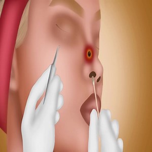 Asmr piercing and Squeezing Acne Treatment | Robin's Garden