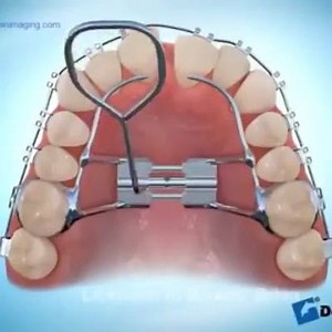 Maxillary expander on upper teeth with braces. #harvandental | Harvan Dental Clinic