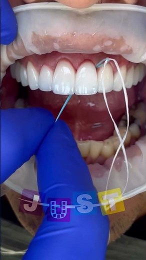 Flossing under a dental bridge 🦷🙌🏻