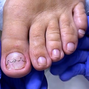 36K views · 293 reactions | Applying a nail correction titanium wire! | Alena Lavrenteva | Facebook