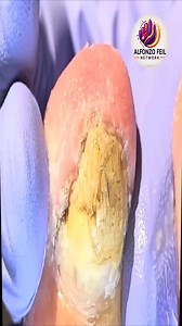 5.2K views · 39 reactions | Smart Toenail Care Tips to Support Daily Nail Health 落 #SafeAtHome #NailCare #AgingWell | Alfonzo Feil | Facebook