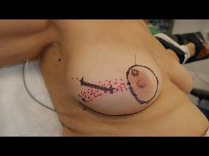 Radioguiaded lateral Access for Segmentary Microcalcifications