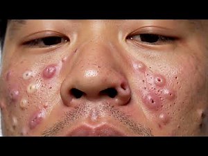 Deep Blackhead Pulling | Nose Pore Extraction