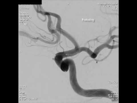 Endovascular Aneurysm Coiling