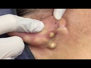 Infected Ear Cyst | Pimple Popping | Relaxing & Satisfying #5