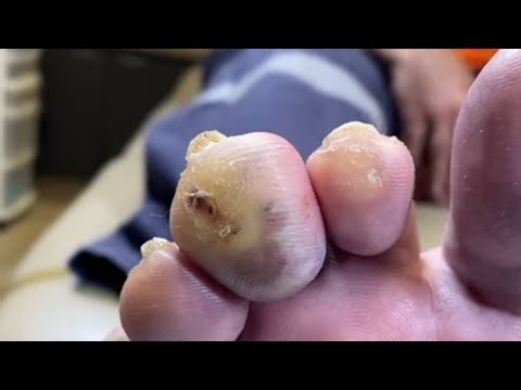 Drainage of an infected pressure ulcer on the toe