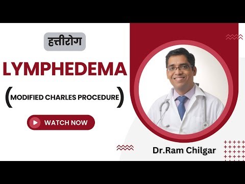 Modified charles procedure | lymphedema | #lymphedema