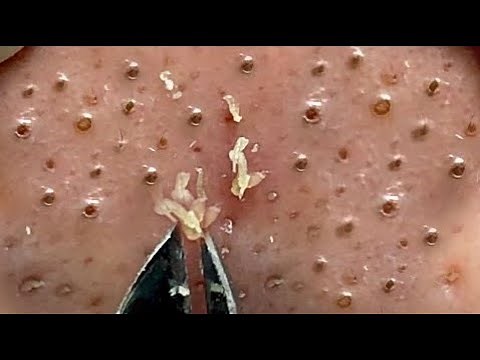 Best Satisfying Nose Plucking Blackheads Whiteheads Removal | Acne Treatment #24