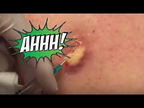 Howard's Big Back Blast! Cysts, Cyst Removal, Pimple Popping