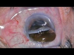 manual extracapsular cataract extraction Long