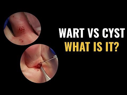 Wart vs Cyst Removal