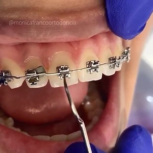 Self ligating brackets 醴 by @monicafrancoortodoncia . Self-ligating brackets are defined as "a dental brace, which generally utilizes a permanently installed, moveable component to entrap the archwire". Self-ligating brackets have also been designed which do not require a movable component to hold the wire in place. | Dentistry blog | Facebook