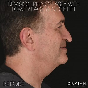 Revision Rhinoplasty with Lower Face & Neck Lift by Dr. Kian Karimi