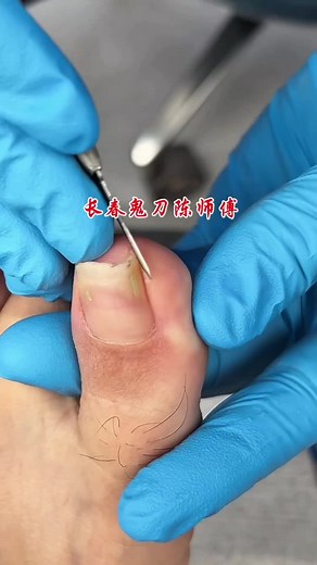 Satisfying Toenail Cleaning Transformation