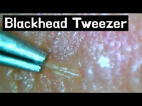 #21 Pull out Blackheads lips / Whiteheads Close up 300X - Blackheads Removal