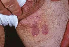 Home Remedies For Jock Itch That You Can Try at Home