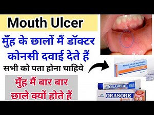 मुँह के छाले (mouth ulcer ) की medicine - Stomatitis treatment